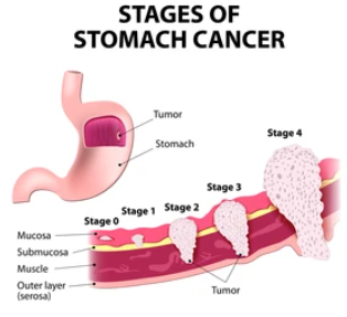 위암 4기 생존율