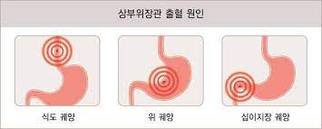 상부소화관출혈
