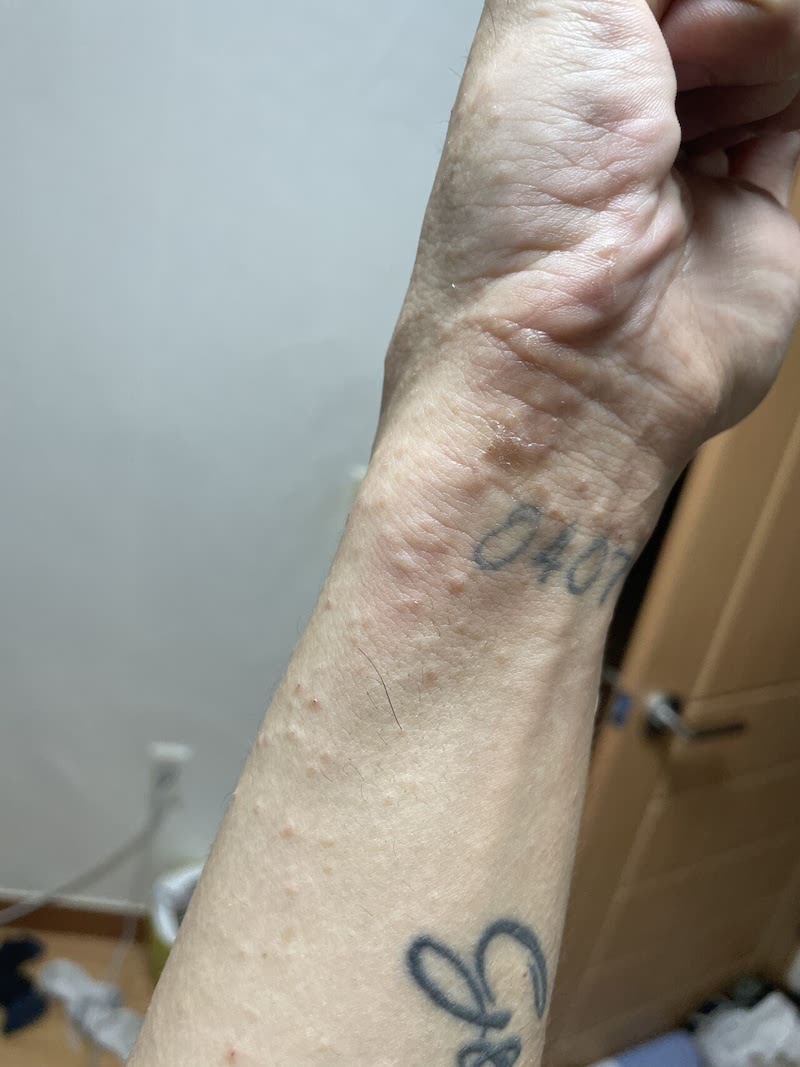 화이자 백신 접종 후 전신 두드러기와 피부 발진 가려움증