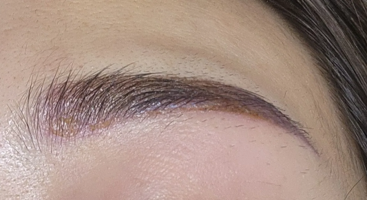 염증 치료후 딱지발생