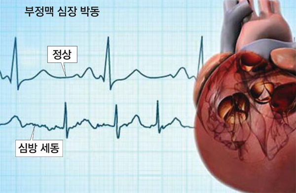 부정맥