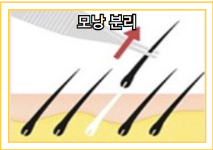 탈모 치료 - 모발 이식