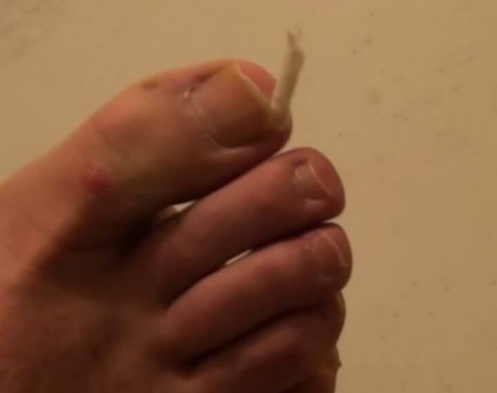 내성발톱 자가치료 치실