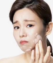 백반증 초기증상 20