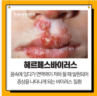 헤르페스바이러스