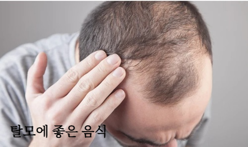 탈모에 좋은 음식 알아보기&amp;#44; 탈모 원인