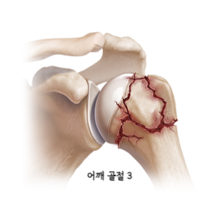 어깨통증원인