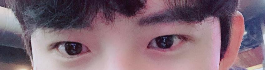 안검하수 후기
