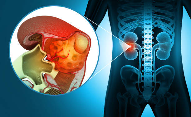 요로결석의 원인과 통증
