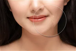 팔자주름 없애는 방법