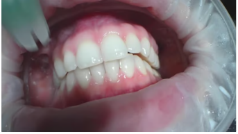 앞니 임플란트 주의사항