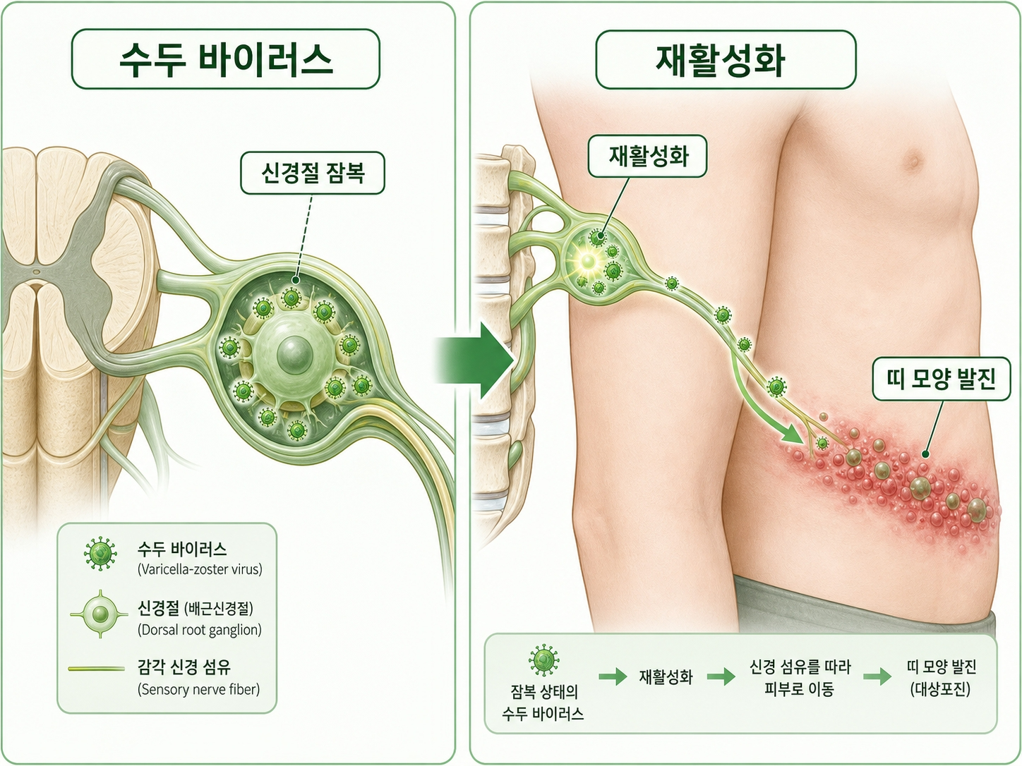 대상포진 재발 원인 바이러스 재활성화 과정