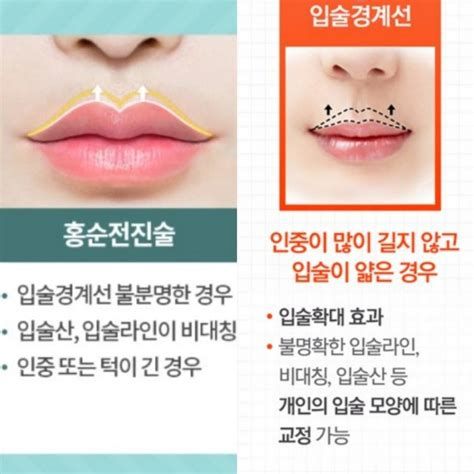 인중 축소 수술