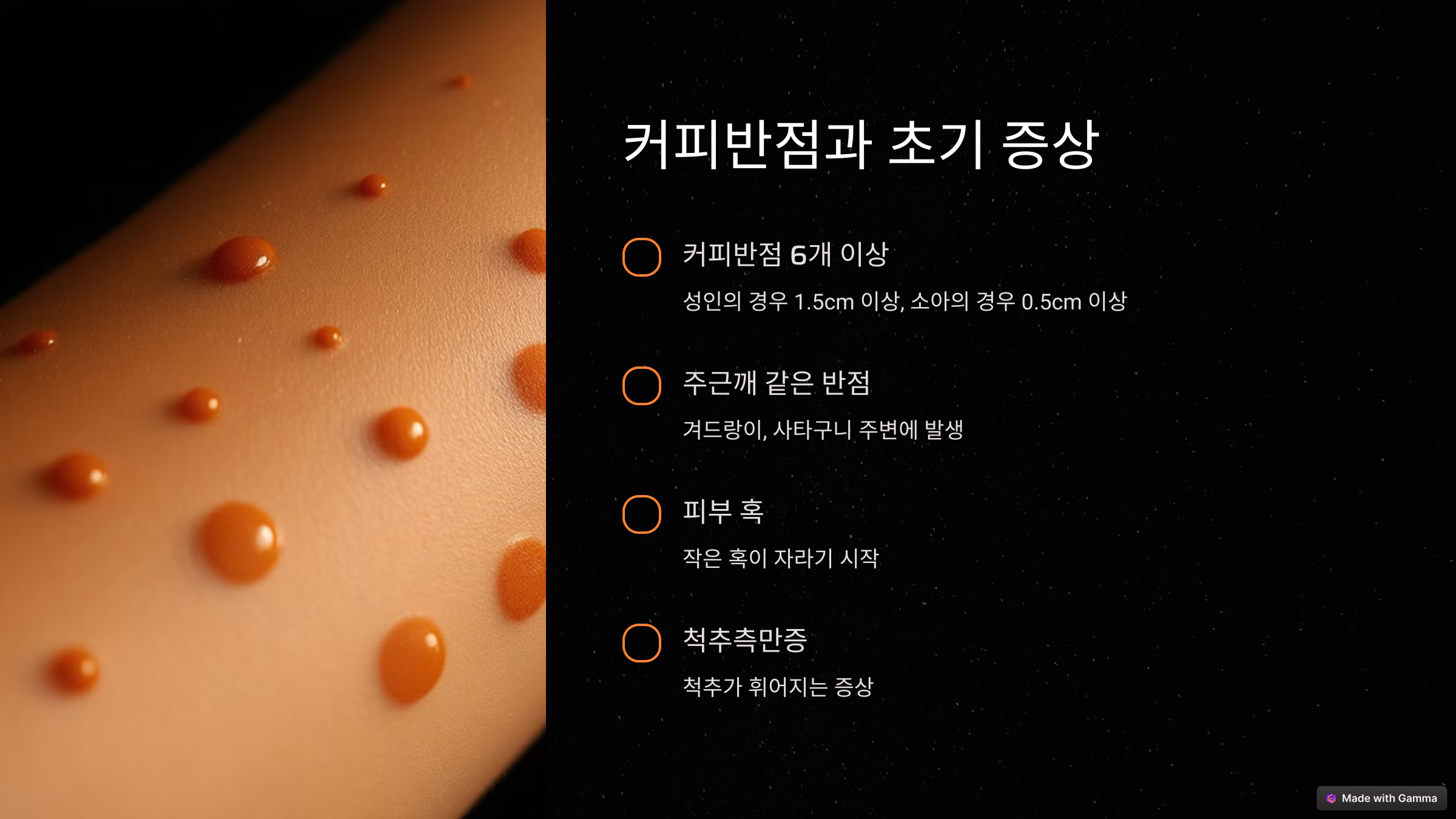 신경섬유종 커피반점 초기에 잡아야 한다! 초기 증상과 예방법