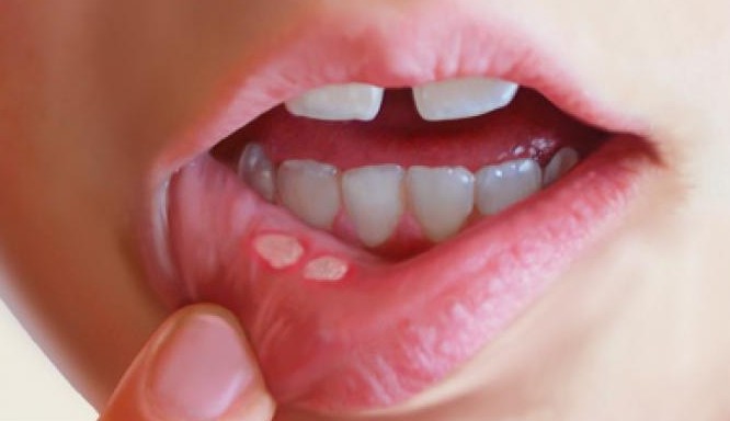 구내염 종류과 증상, 2주이상 지속시 구강암 전조증상일 수도