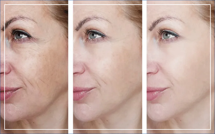 엘란쎄 필러 전 후