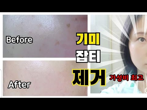 기미 없애는 방법
