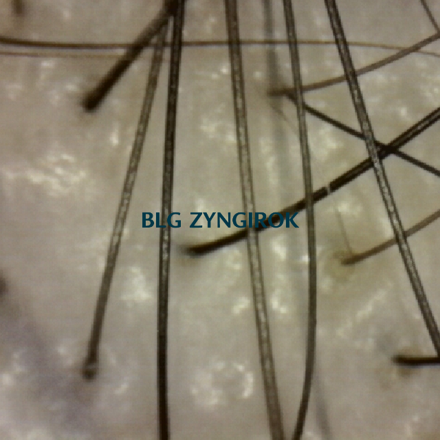 탈모 극복 프로젝트 - 정수리와 이마 사이 두피 사진 모습이다.