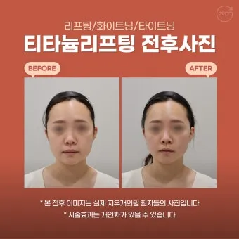 덴서티 리프팅 댄서티 가격 효과 유지기간에 관한 정보_18