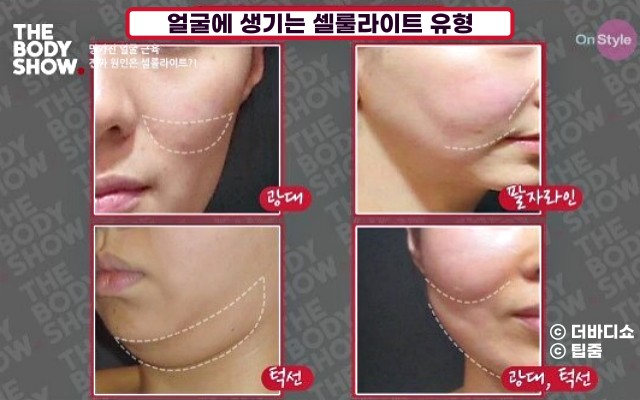 얼굴 셀룰라이트 없애는 음식, 셀룰라이트 없애는 법