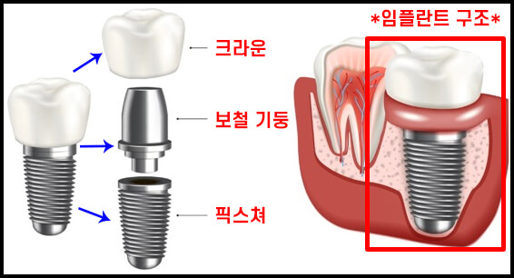 임플란트 구조 설명 사진
