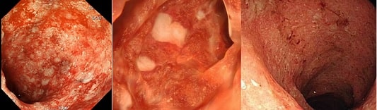 내시경으로 촬영된 궤양성 대장염