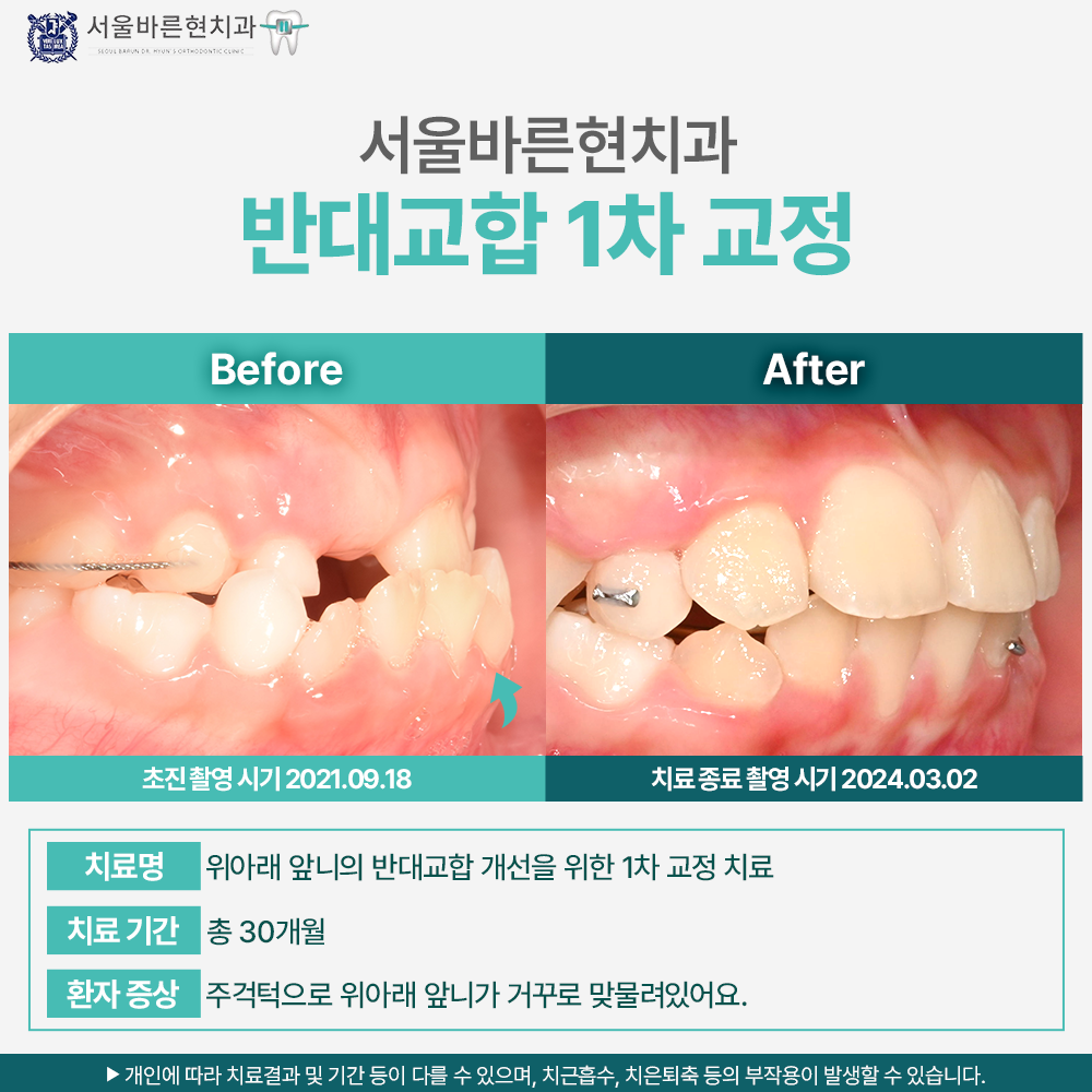 부산 치아교정