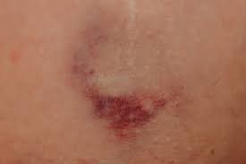 멍이 잘 드는 이유와 예방 방법