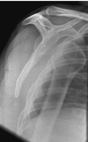 dislocation