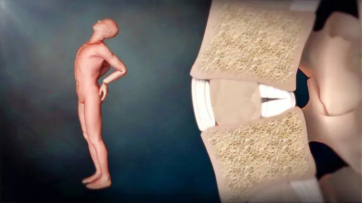 명의 허리통증 치료 디스크 수술 없이 낫게하는 자세 치료법 재활의학과 정선근 교수