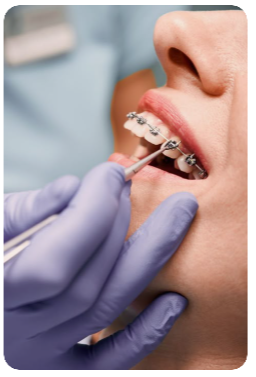 치아교정술-비용