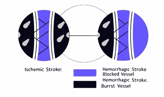 뇌졸증 치료과정