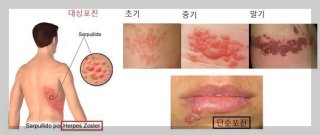 대상포진 초기 중기 말기