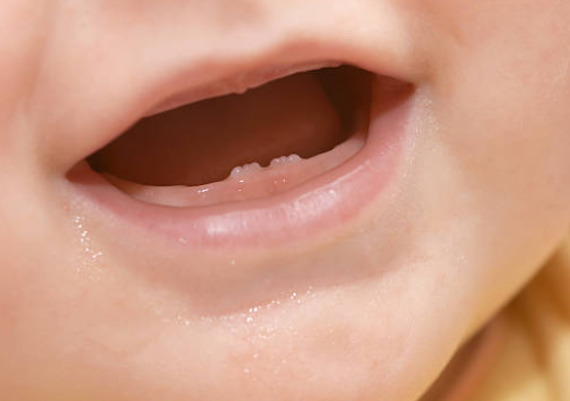 아기 이앓이 시기 및 증상