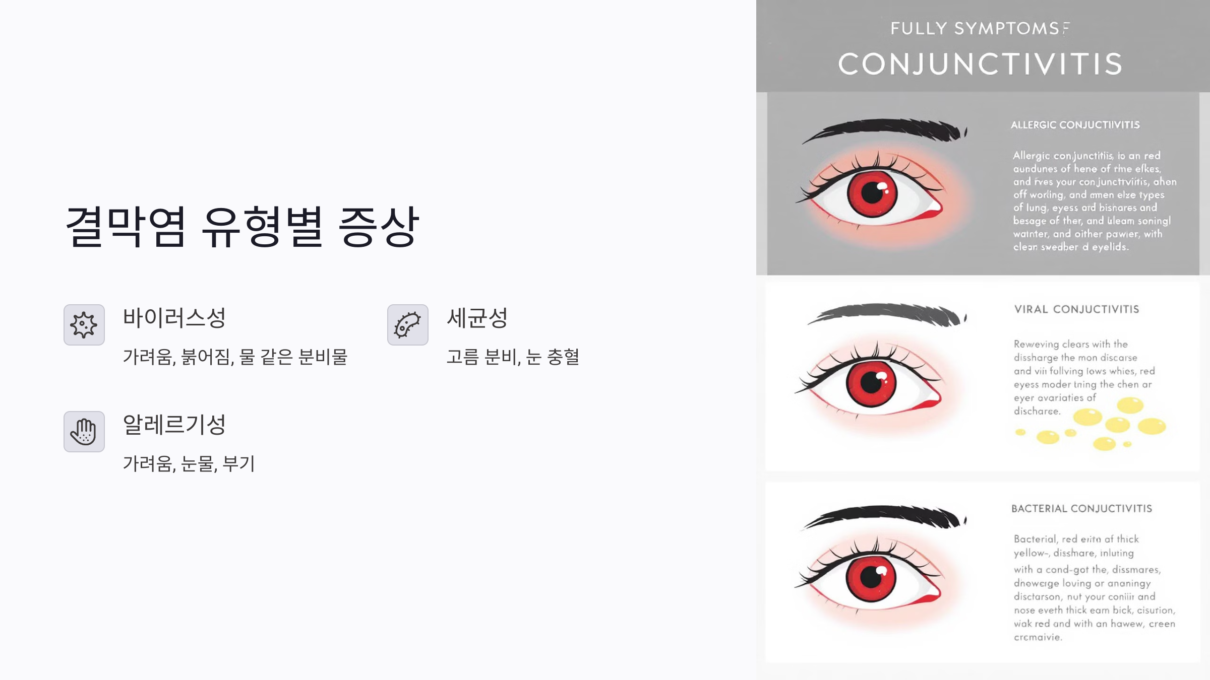 결막염 증상과 치료법, 예방을 위한 생활수칙 10가지