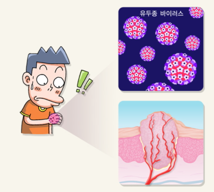 사마귀의 원인
