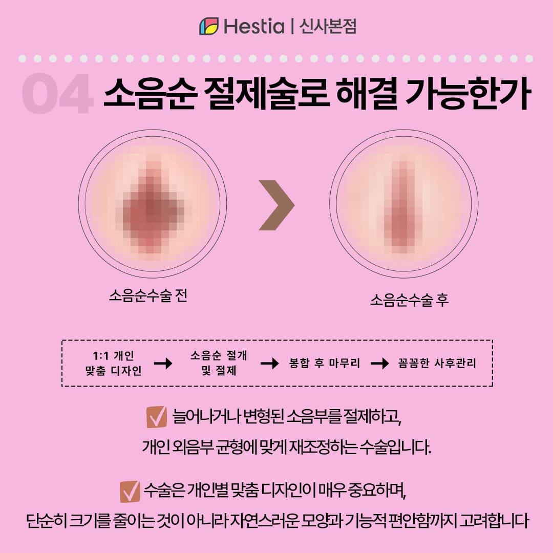 소음순 절제술로 해결 가능한가