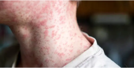 베트남에서 홍역에 감염되었을 때 꼭 해야 할 5가지 조치