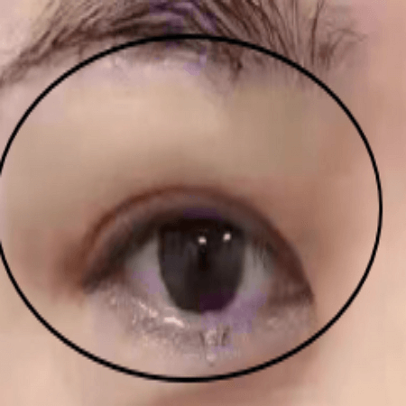 눈썹거상술 후 남성의 모습