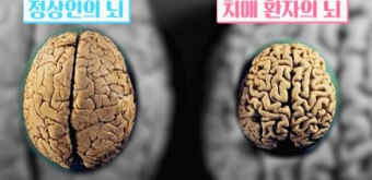 노화된 뇌의 모습