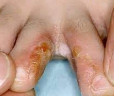 지간형 발무좀 (Interdigital type)