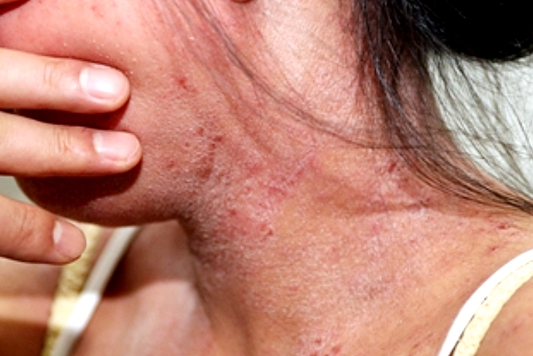 아토피-피부염-이미지