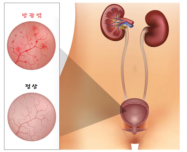 방광염