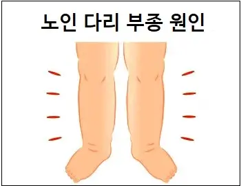 노인 다리 부종 원인