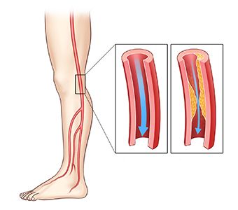 말초혈관질환 증상