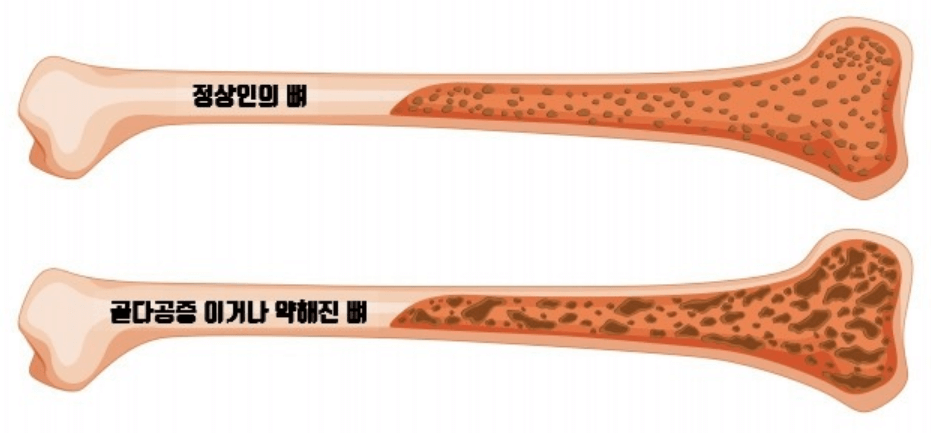골다공증-정상인-뼈-사진-비교