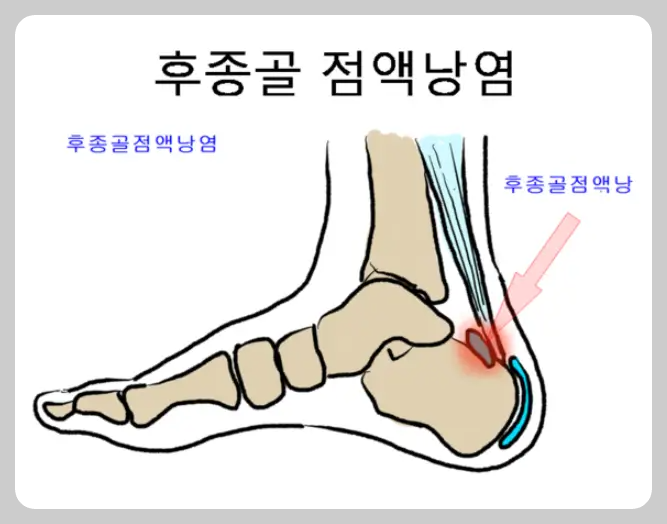 후종골 점액낭염