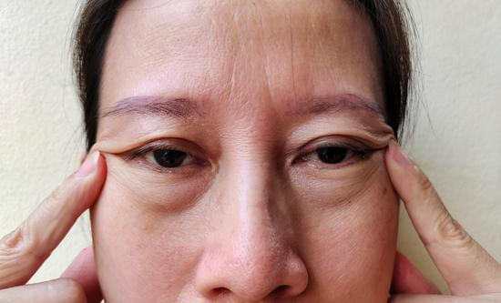 안검하수 (Blepharoptosis)의 원인과 치료