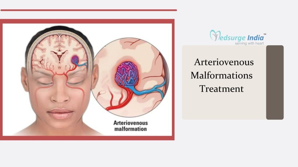 뇌 동정맥 기형 뇌출혈