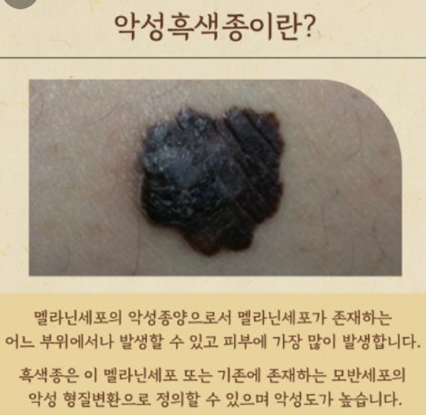 악성흑색종